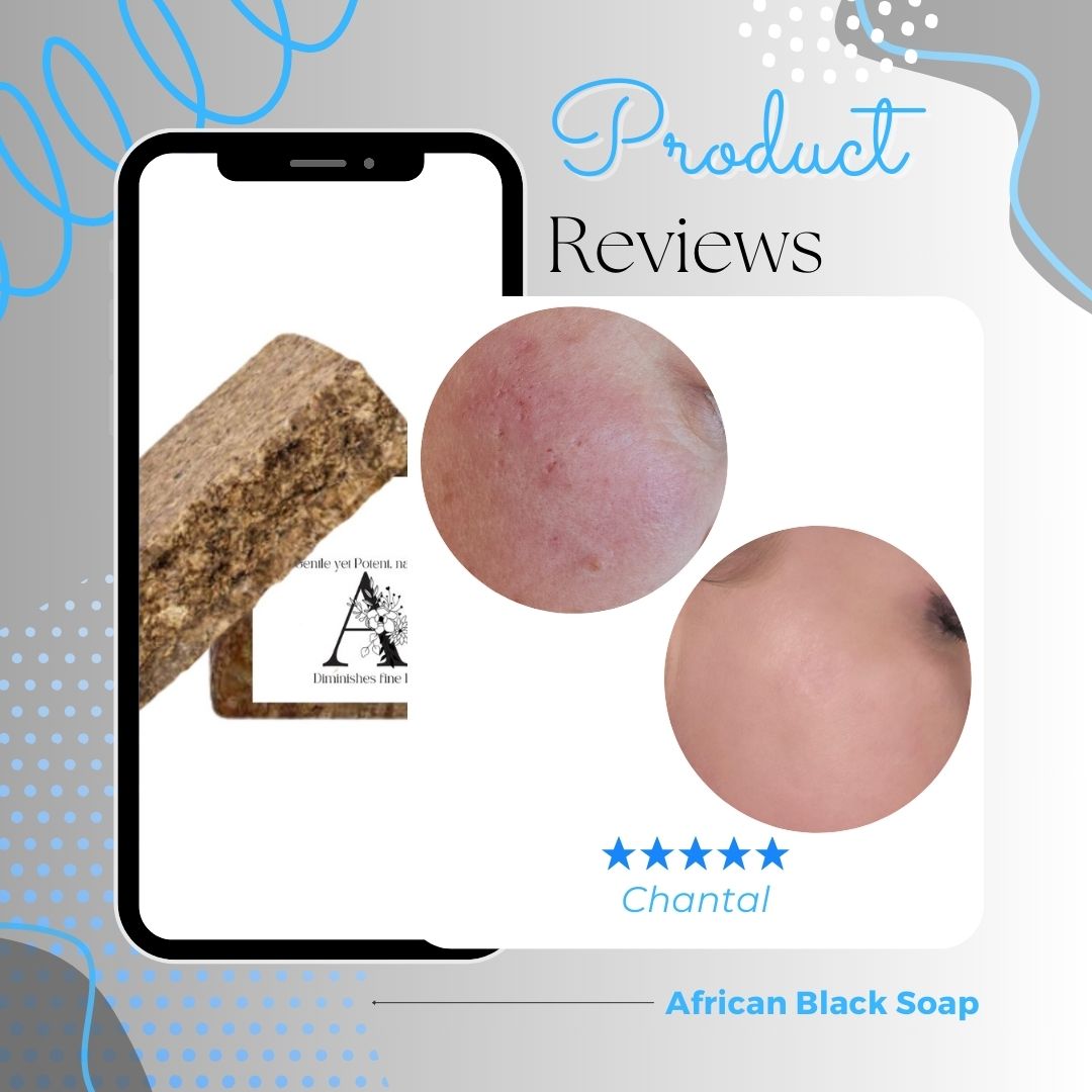 Cystic Acne Results - African Black Soap